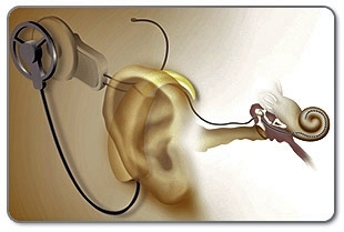 Reproduo artstica de um implante coclear em um