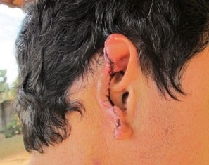 Cirurgia para reconstru��o da orelha pode custar R$ 35 mil