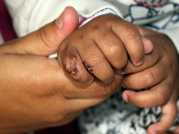 A criana teve queimaduras nas costas, cabea e mos