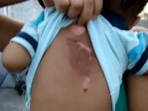 Beb teve parte das costas queimada aps banho