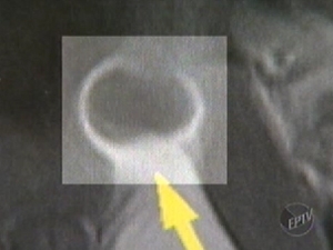 Recepcionista no sabe se objeto foi esquecido durante cirurgia para retirada de hrnias ou se em parto cesariana