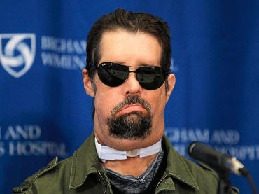 Dallas Wiens, 25 anos, recebeu o transplante aps ter sido atingido por um fio de alta-tenso