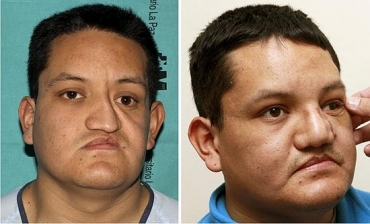 Equatoriano tem parte da estrutura ssea facial reconstruda a partir de prtese de cermica